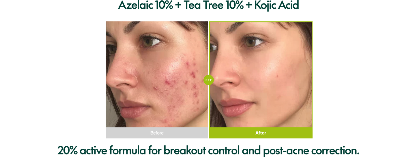 Purito SEOUL - Azelaic Acid 10 Kojic Tea Tree Serum